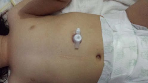 alimentação por gastrostomia