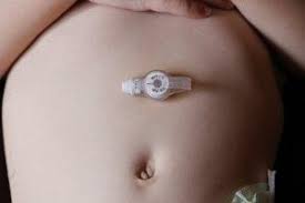 alimentação por gastrostomia